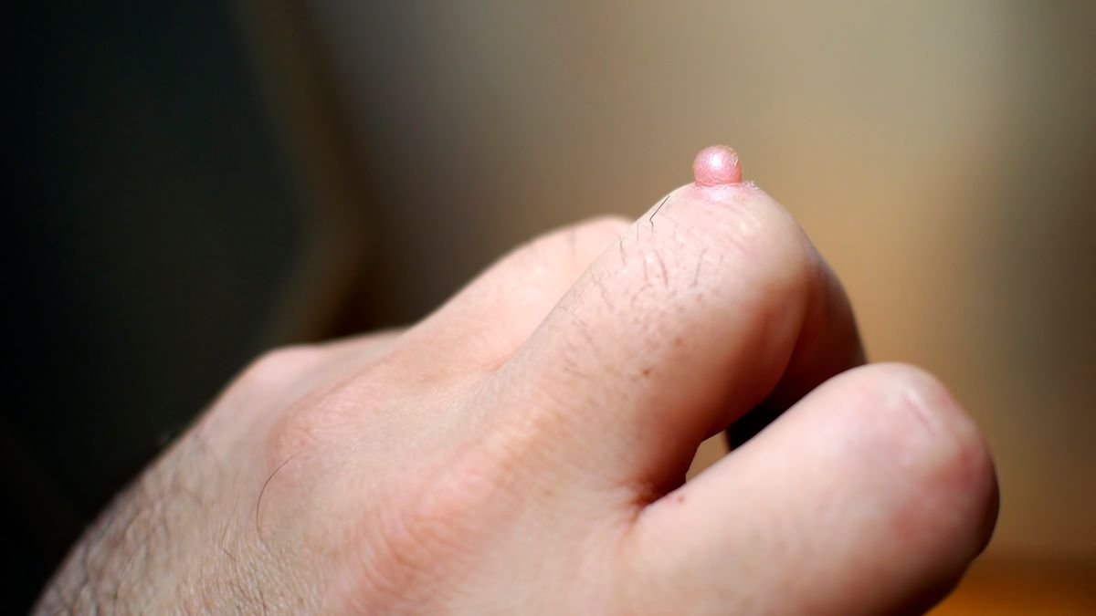 Brodawki wirusowe to niewielkie narośle na skórze, spowodowane wirusem brodawczaka ludzkiego, czyli HPV.