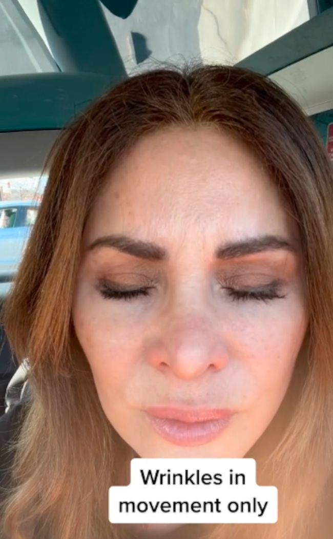 Wstrzykiwała sobie botoks przez 20 lat i przestała. Efekt podzielił internautów