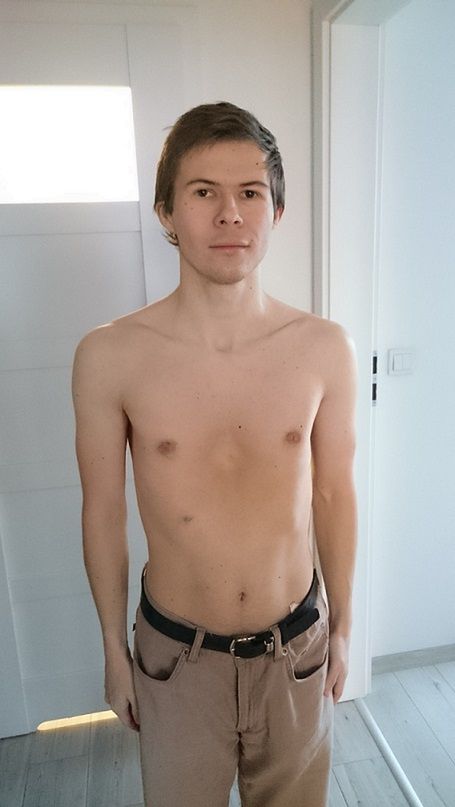 Rafał ma zdeformowaną klatkę piersiową