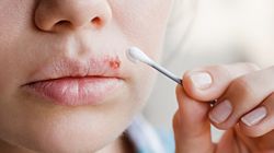 Domowe sposoby na opryszczkę. Przyczyny i objawy opryszczki