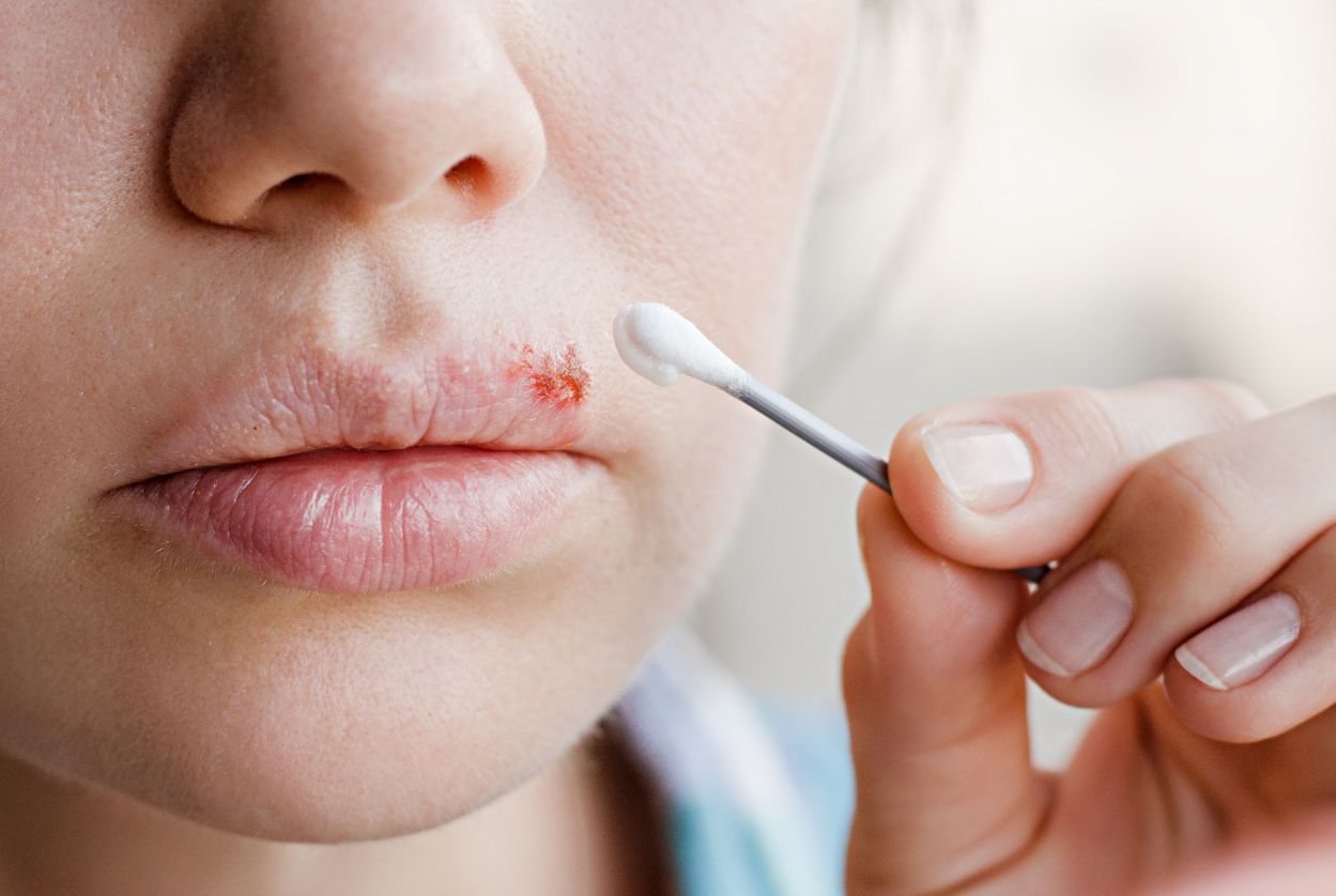 Domowe sposoby na opryszczkę. Przyczyny i objawy opryszczki