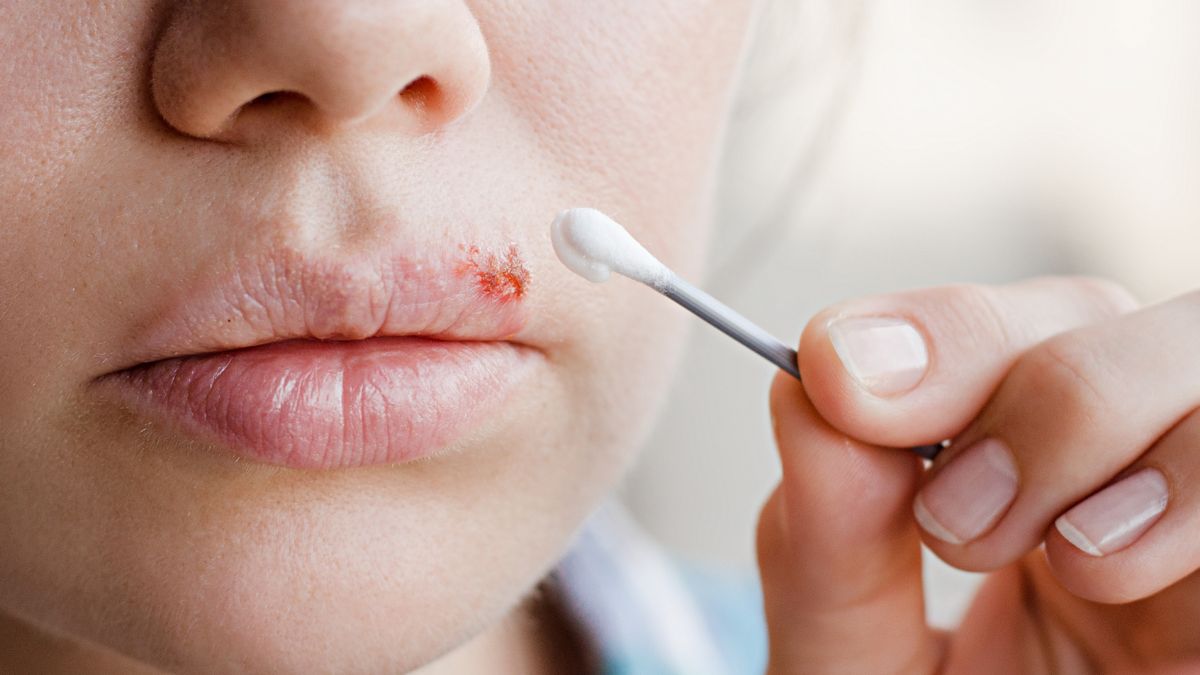 Domowe sposoby na opryszczkę mogą działać przeciwzapalnie i przeciwwirusowo.
