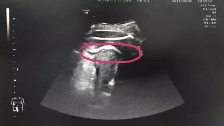 Zdaniem lekarzy nienarodzona córka tak mocno kopnęła w ścianę macicy, że ta nie wytrzymała i pękła
