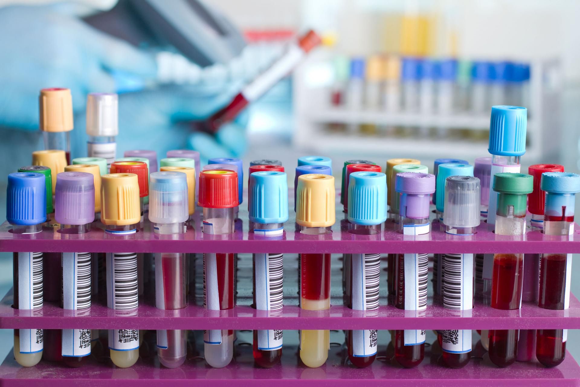 Morfologia z rozmazem jest podstawowym badaniem do zdiagnozowania np. białaczki