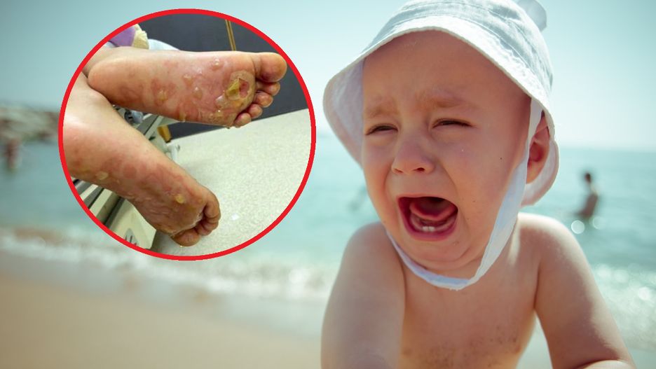 Zaczęła płakać na plaży. Z poparzeniami stóp trafiła do szpitala