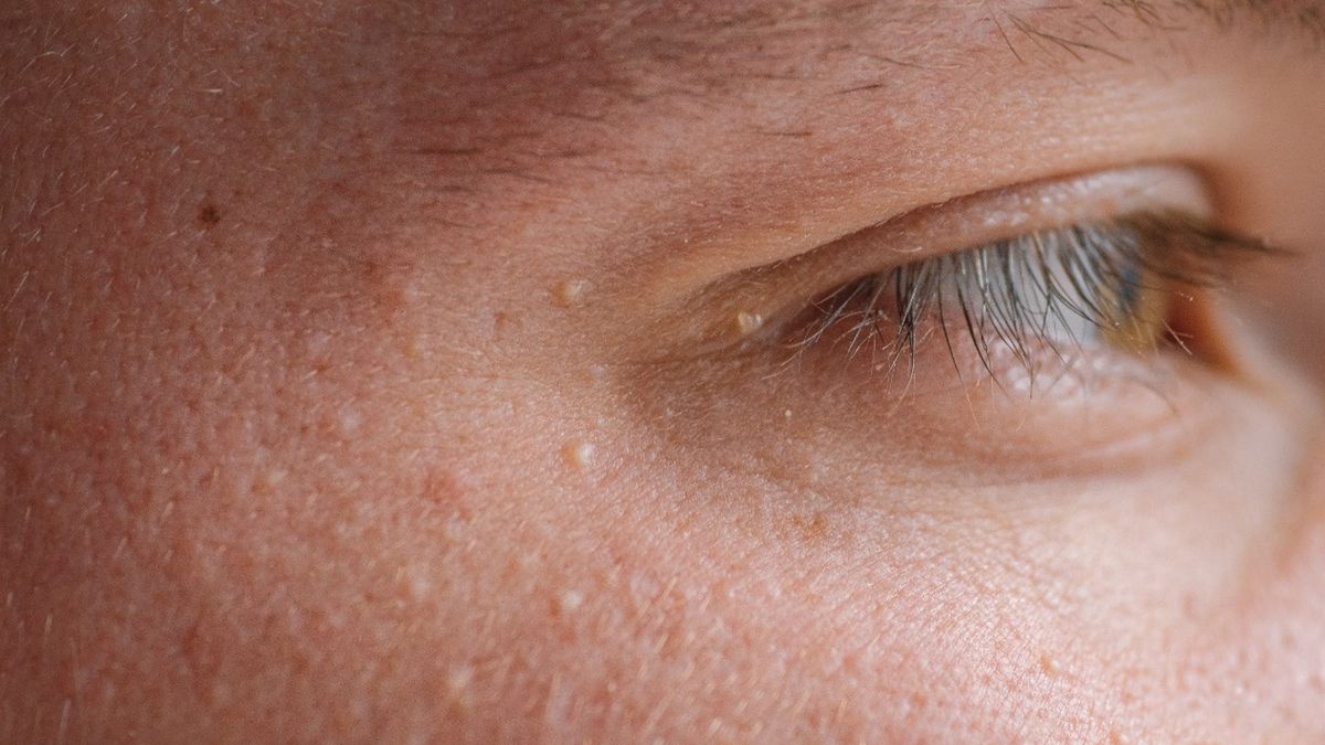 Prosaki to niewielkie torbiele podnaskórkowe, które powstają najczęściej obrębie policzków, nosa oraz skroni.