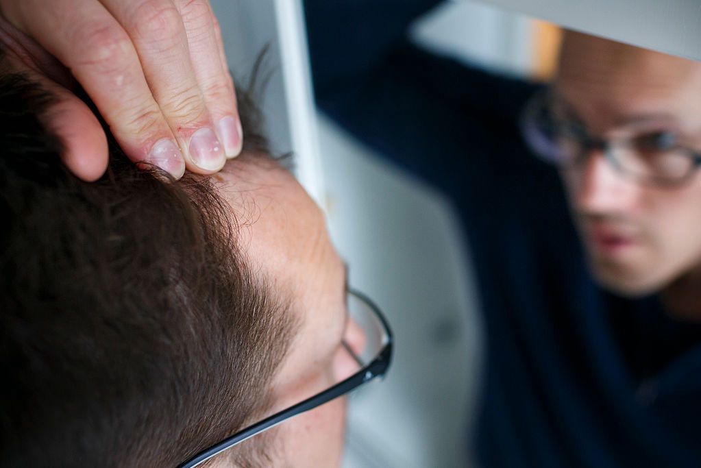 Jak dziś leczyć łysienie? Lekarze o najskuteczniejszych metodach