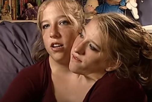Abigail & Brittany Hensel