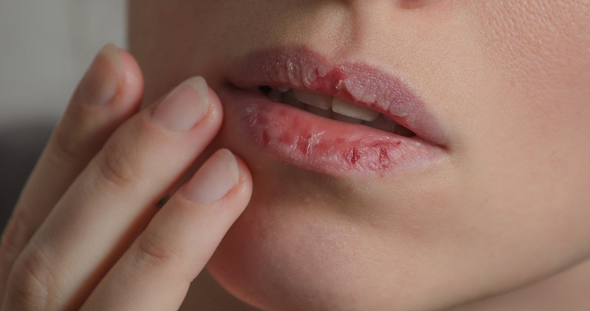Na spierzchnięte usta wpływa wiele czynników wewnętrznych, jak i zewnętrznych