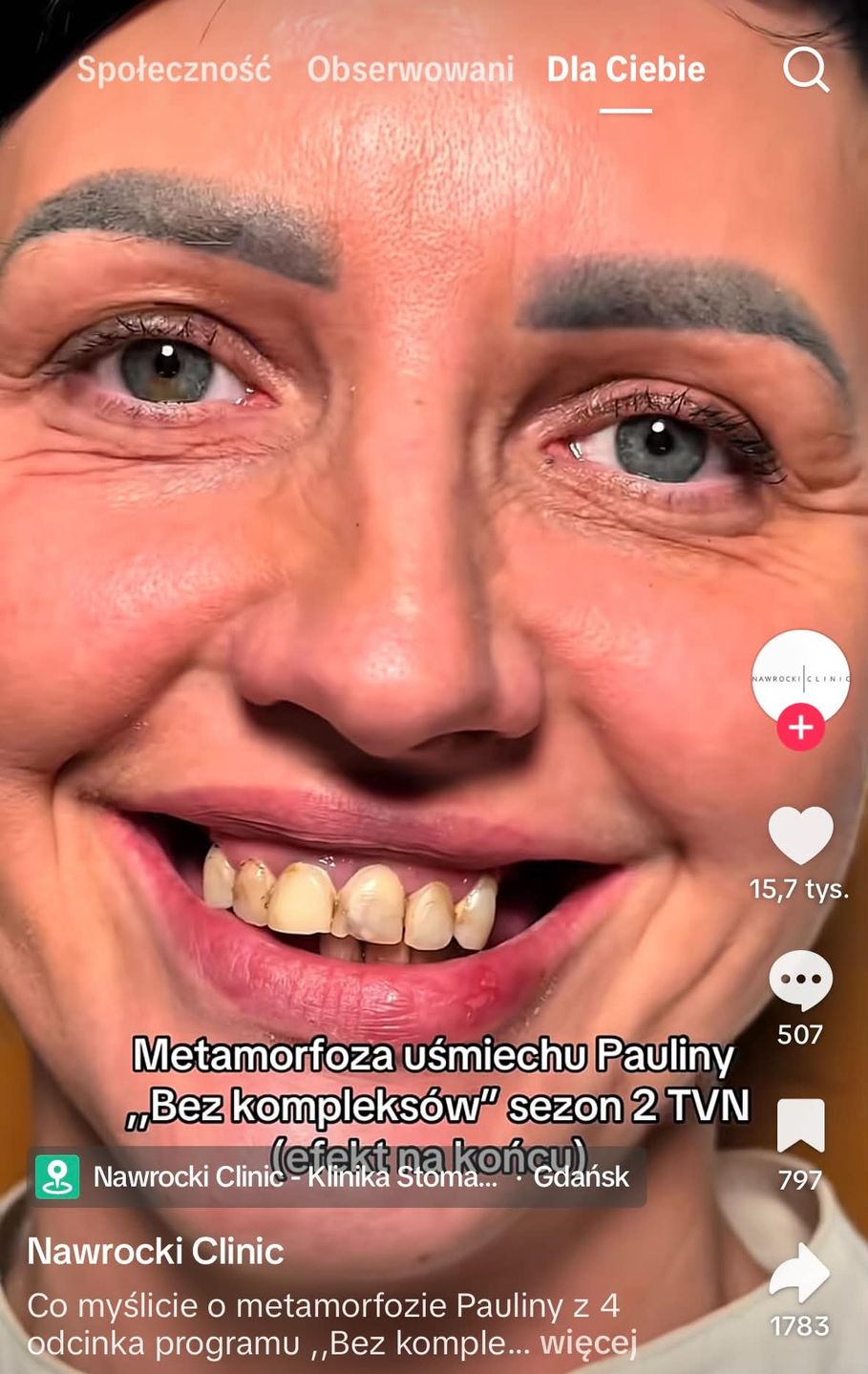 Metamorfoza zębów uczestniczki w programie "Bez kompleksów"