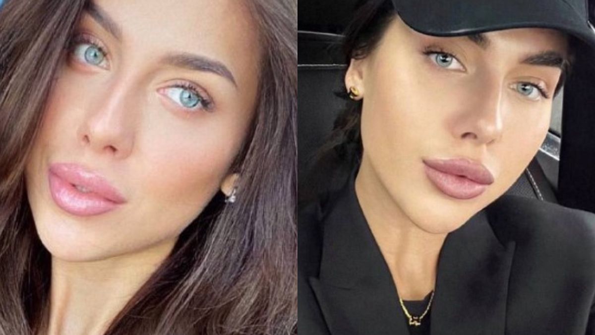 Modela z Moskwy jest w śpiączce po operacji nosa.