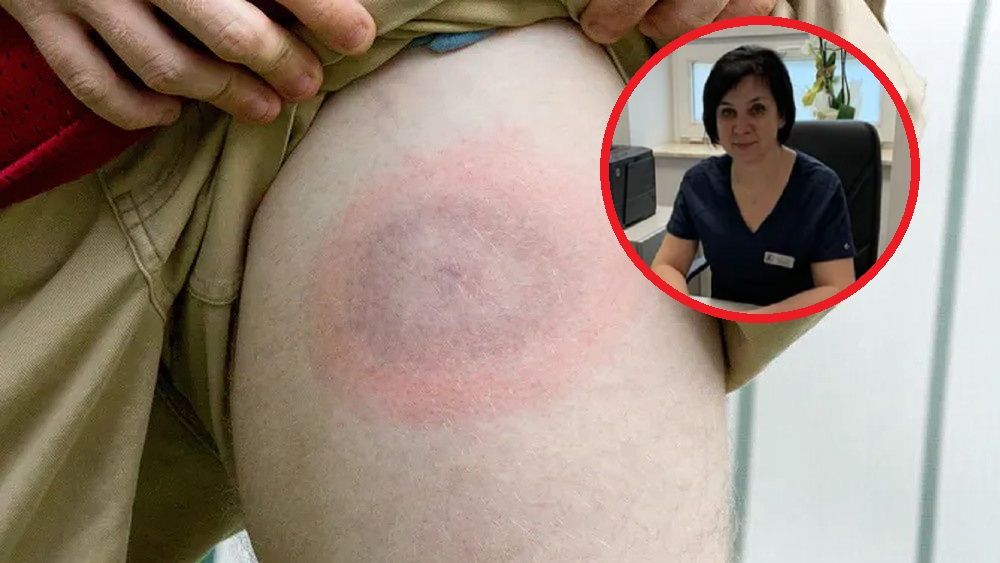 Zaczyna się sezon na kleszcze. "Będziemy mieli wysyp takich przypadków"