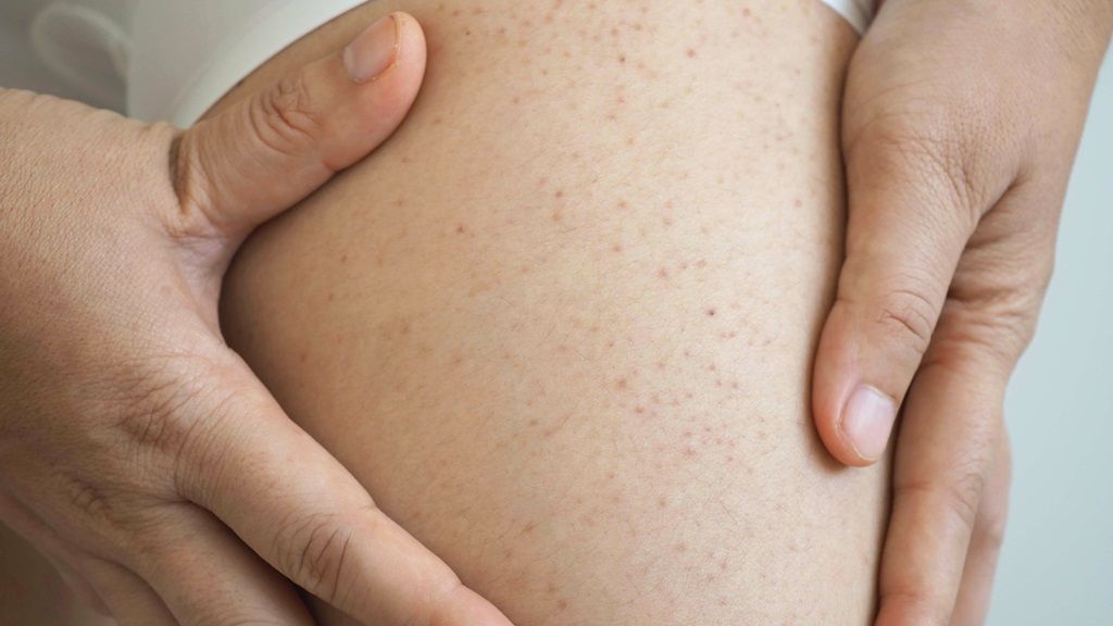 Trombocytopenia może objawiać się drobnym krwawieniem podskórnym, przypominającym wysypkę