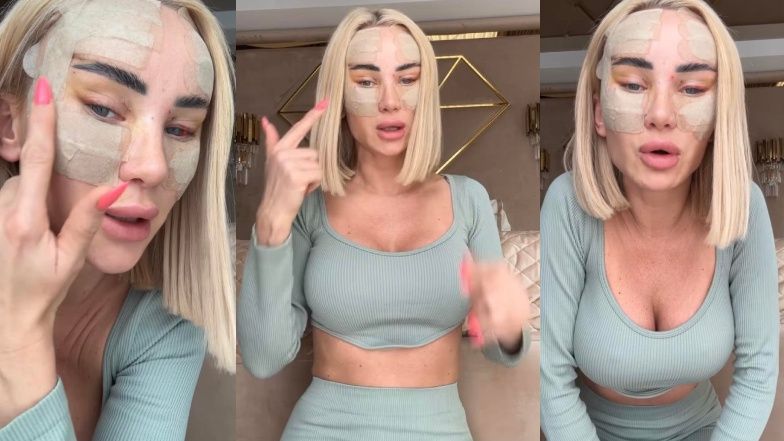 Izabela Macudzińska pokazała opuchniętą twarz po kolejnej operacji: "Zobaczcie, jak pięknie schodzi kolorek żółty" (FOTO)