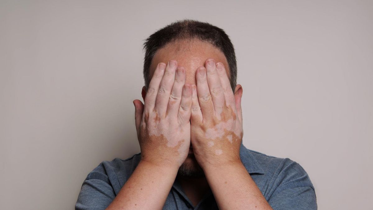 Bielactwo nabyte nie ma jeszcze do końca ustalonych przyczyn