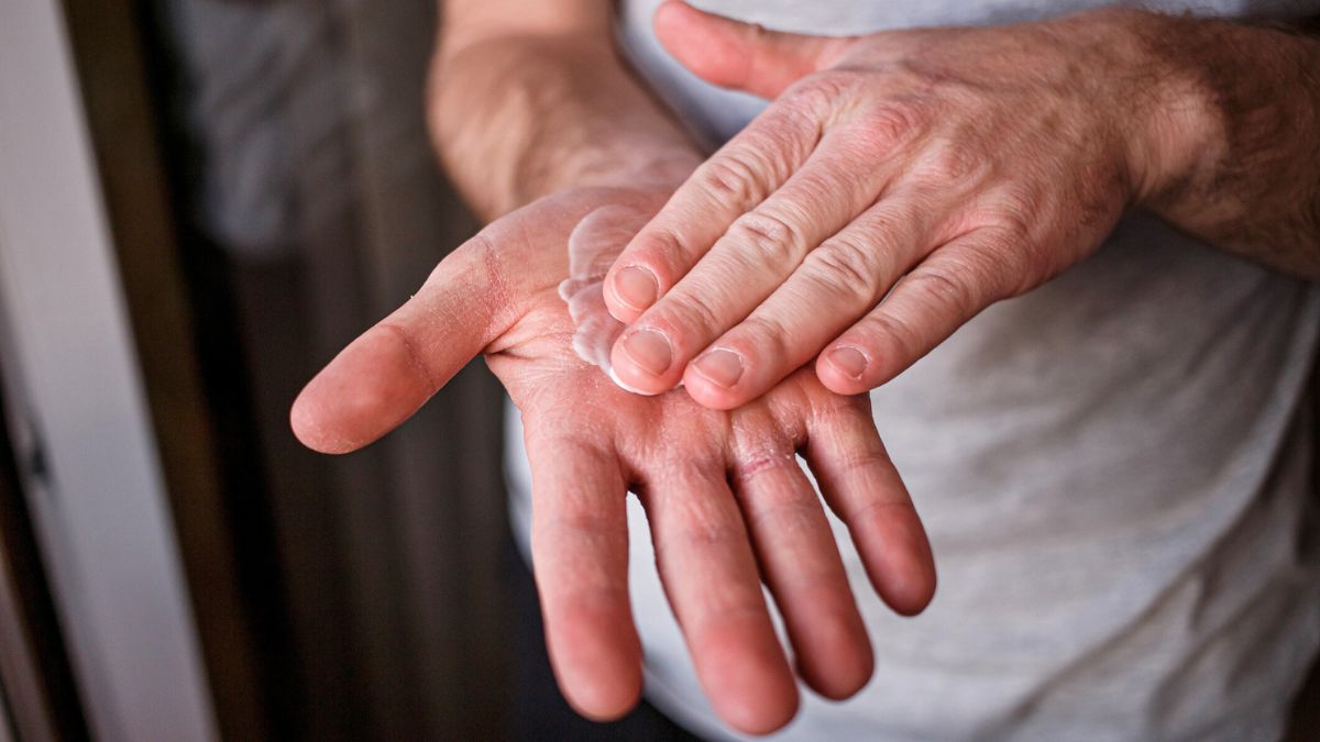 Mężczyzna naciera dłonie kremem