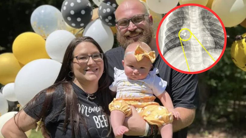 Rodzice ostrzegają przed ozdobami dla dzieci. Kolczyk utknął w płucu ich córki