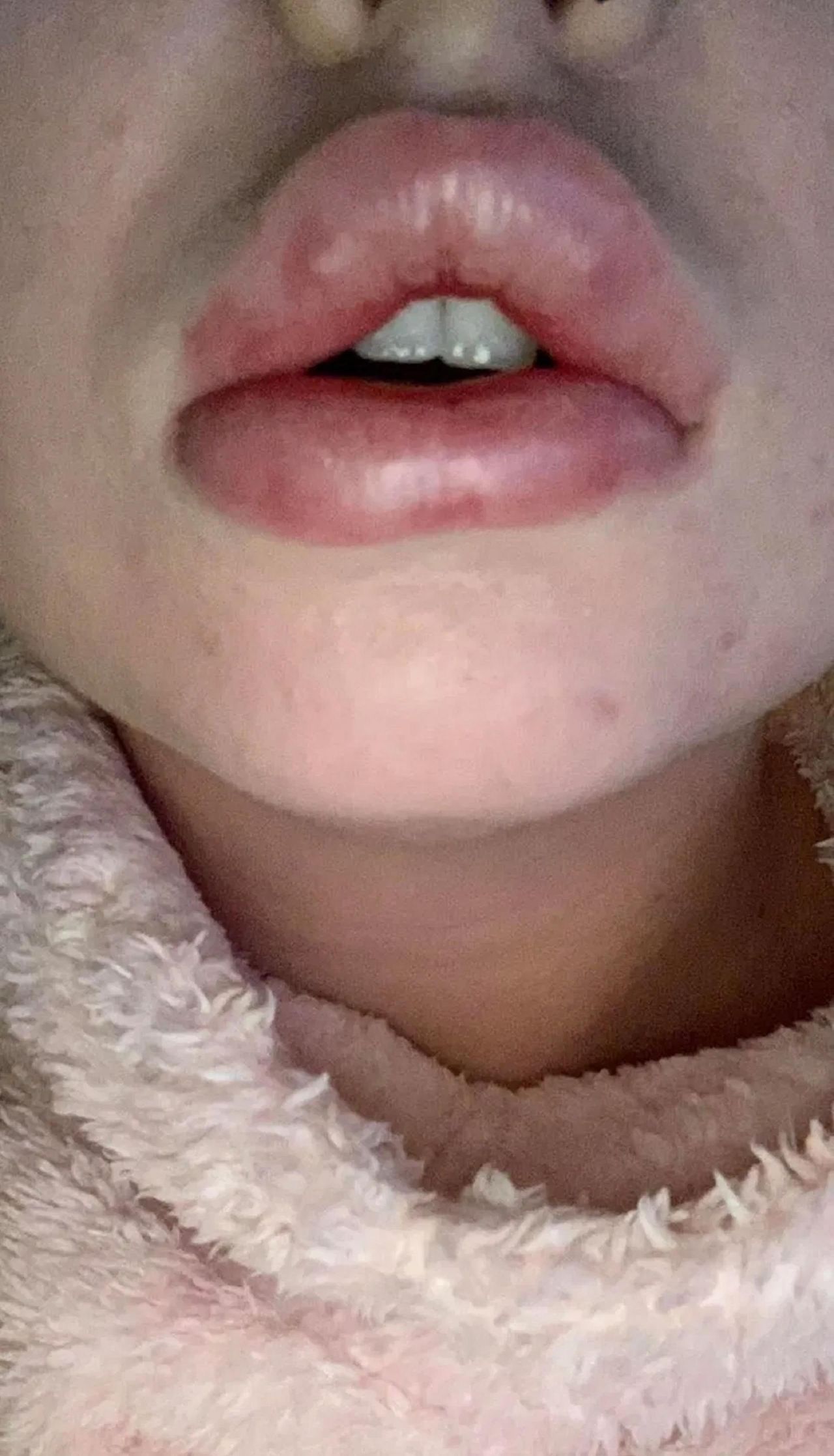 Miała "usta jak kiełbaski". Młoda mama opowiada o swoim traumatycznym doświadczeniu z botoksem