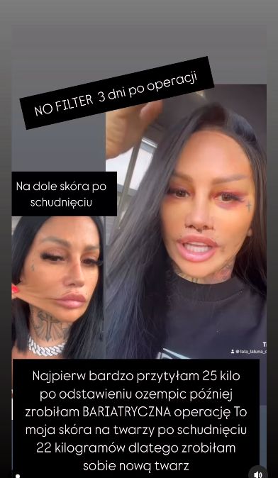 Laluna pokazała się 3 dni po operacji