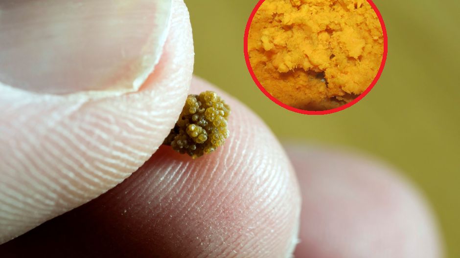 Kamica nerkowa często jest skutkiem nieprawidłowej diety