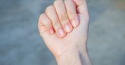 Przyjrzyj się paznokciom. Mogą sygnalizować objawy choroby płuc lub cukrzycy