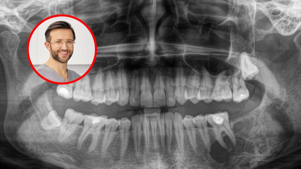 Wykryta zmiana nowotworowa w szczęce podczas wizyty u ortodonty