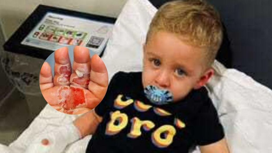 Odkurzacz wessał rękę dziecka. Chłopiec doznał oparzeń i wstrząsu toksycznego