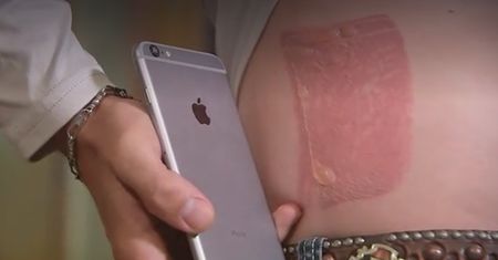 IPhone zranił mężczyznę. Doznał poparzeń 2. stopnia