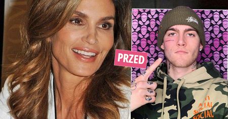 Spore zmiany na twarzy 21-letniego syna Cindy Crawford. Bolesny zabieg dał nieprawdopodobny efekt