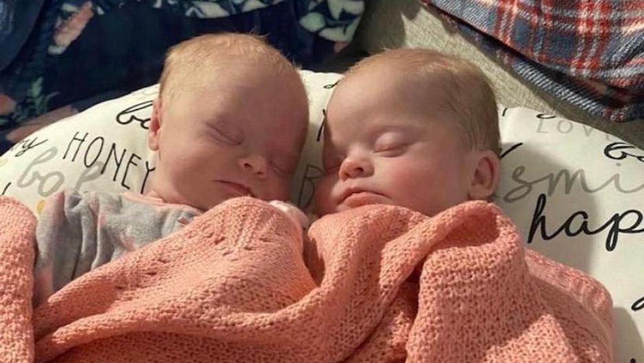 Sugerowali jej aborcję. Tak niezwykłe bliźniaczki wyglądają dzisiaj