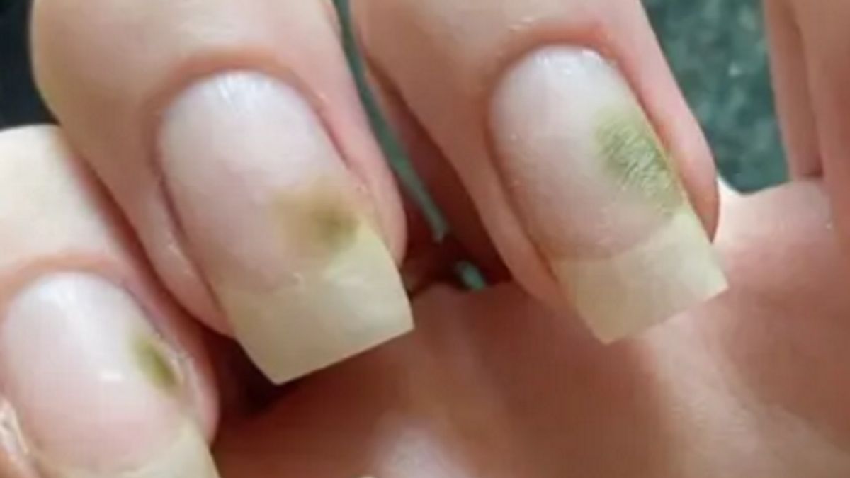 Na paznokciach pojawiła się pleśń