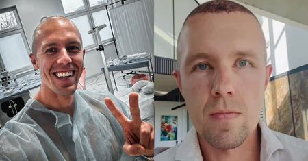 Dawid Piątkowski CHWALI SIĘ efektami po przeszczepie włosów: "Opuchlizna schodzi" (WIDEO)