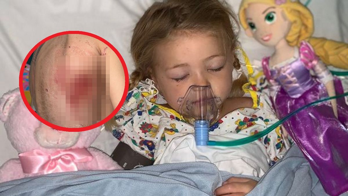 Miała klasyczne objawy ospy wietrznej. 4-latka otarła się o śmierć