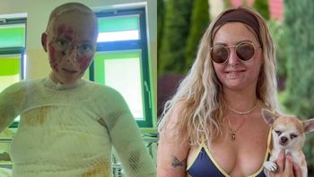 Influencerka, która płonęła żywcem na imprezie, pokazała się w BIKINI. "Życie jest za krótkie na chowanie się" (FOTO)
