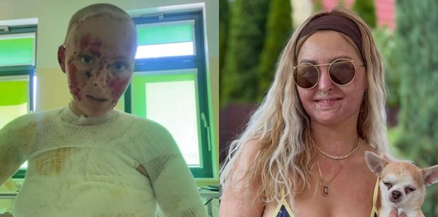 Influencerka, która płonęła żywcem na imprezie, pokazała się w BIKINI. "Życie jest za krótkie na chowanie się" (FOTO)