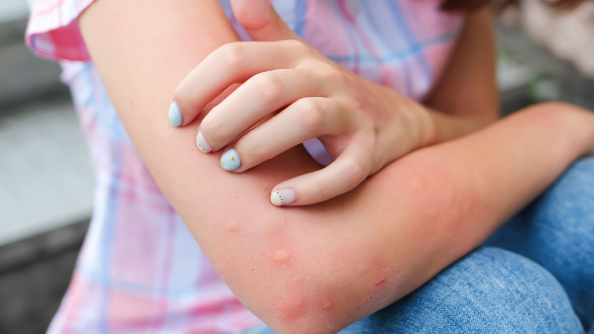 Co zrobić, żeby uniknąć ugryzień komarów? 