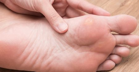 Ukrój plasterek i przyłóż. Odcisk zacznie znikać