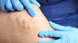 Ostre powikłania żylaków