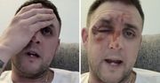 Modny trik z TikTok'a poparzył mu twarz. Teraz ostrzega innych!