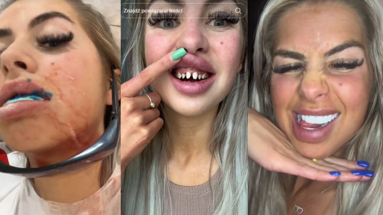 Tiktokerka chwali się "tureckimi zębami"