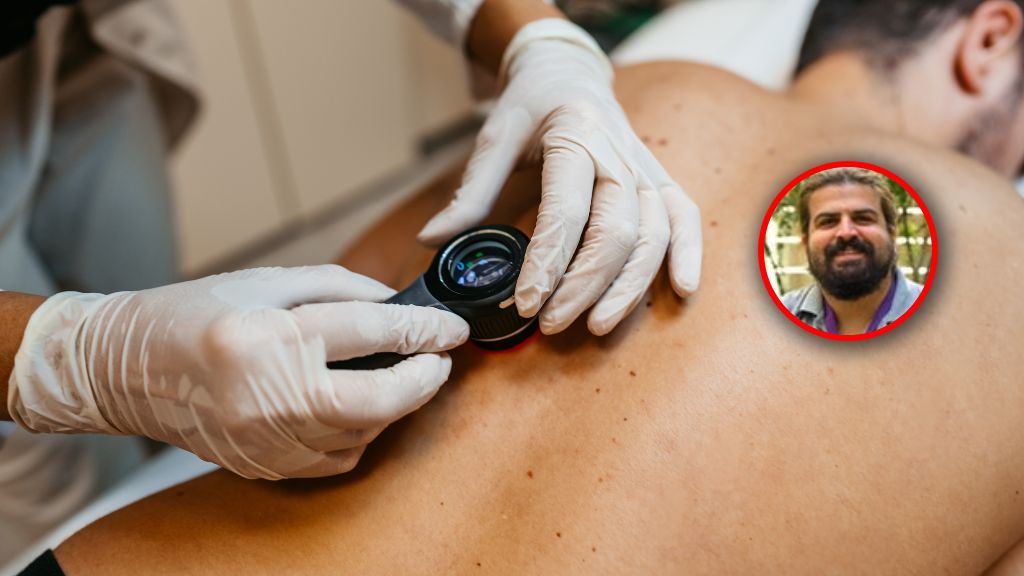 Czerniak to wyjątkowo podstępny nowotwór 