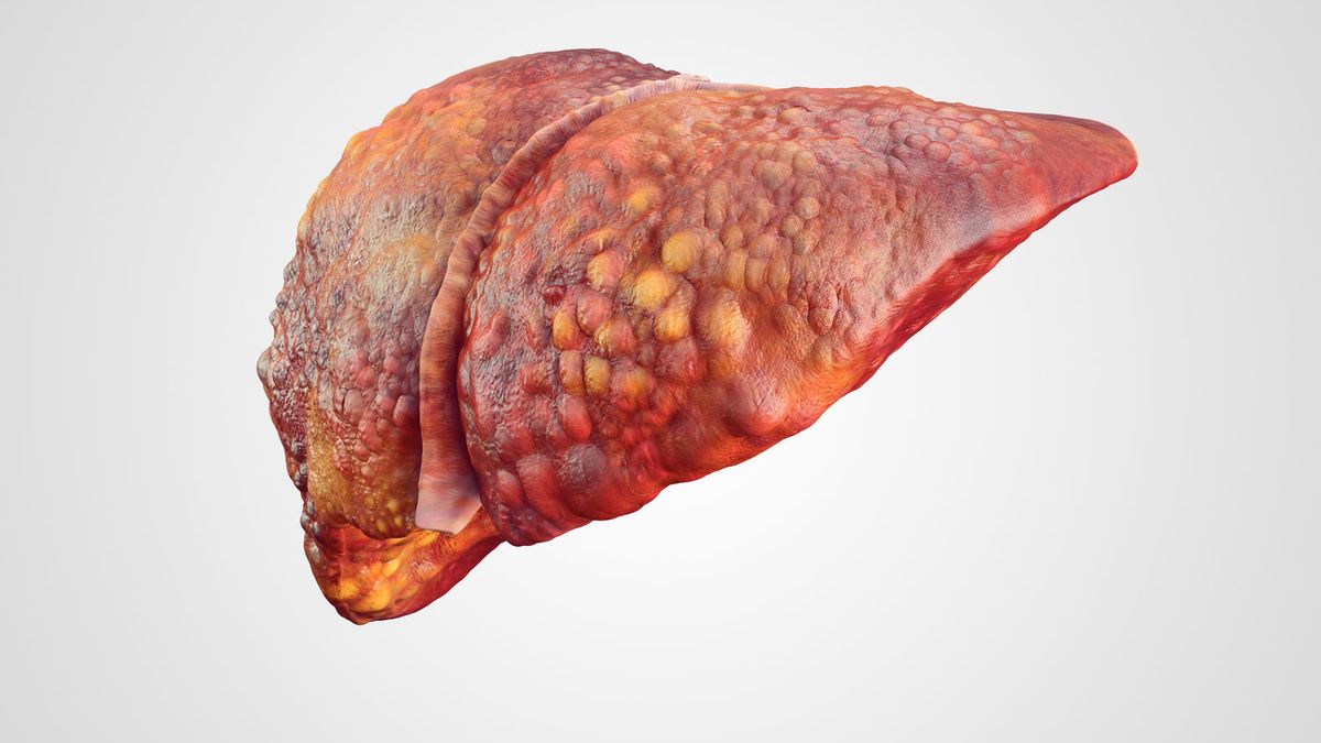 Wątroba z objawami nowotworowymi