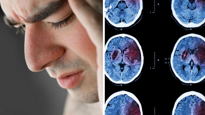 Objawy cichego udaru mogą zwiastować pojawienie się udaru niedokrwiennego