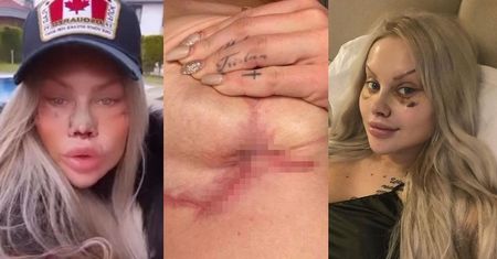 Turecka klinika EwelOny i Laluny Unique oskarżona o NARAŻANIE ŻYCIA klientek! Blizny, infekcje i ropiejące rany! (+18)