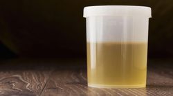 Posiew moczu - wskazania, przebieg badania i interpretacja wyników