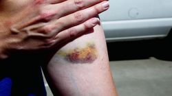 Dwa niepokojące symptomy na skórze. Mogą wskazywać na białaczkę