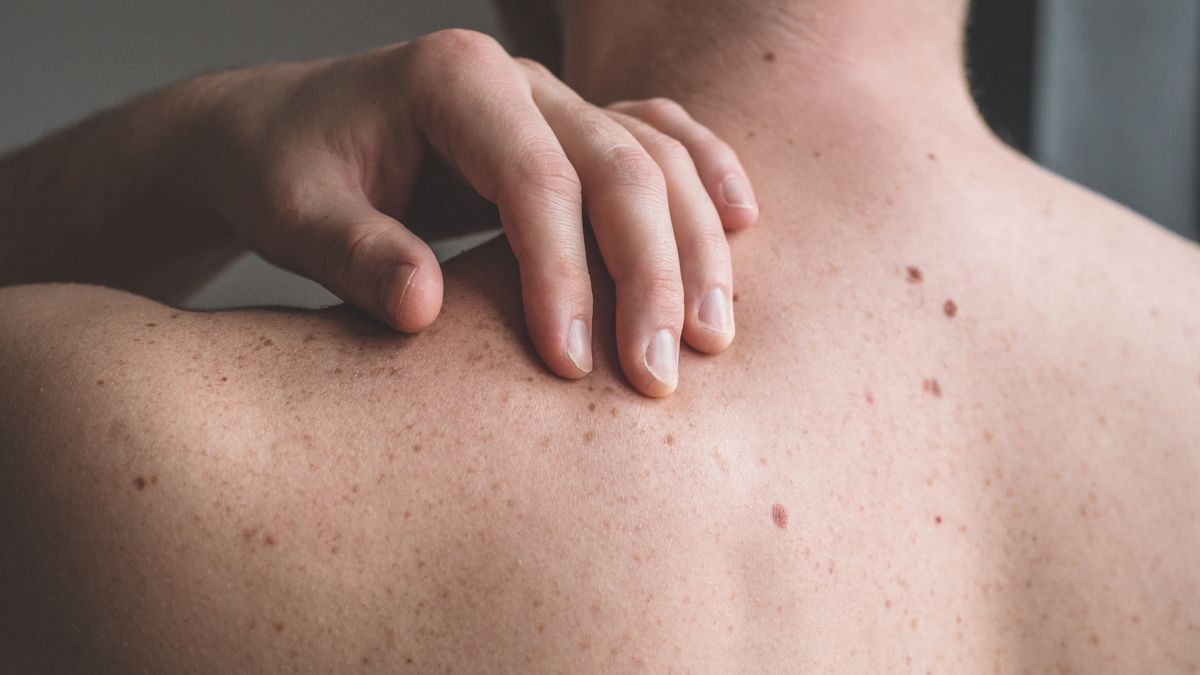 Checking benign moles. Close up detail of the bare skin on a man back with scattered moles and freckles
Checking benign moles. Close up detail of the bare skin on a man back with scattered moles and freckles. Sun effect on skin. Birthmarks on skin
Anastasiia Stiahailo