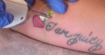Laser wypalił nie tylko tatuaż. Zobacz, jak łatwo zniszczyć aparat