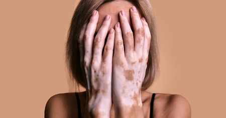 Hipopigmentacja (białe plamy na skórze) - rodzaje, przyczyny, diagnostyka, leczenie