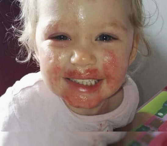 Tajemnicza choroba "zjadała" małą dziewczynkę. Ustalenie przyczyny trwało osiem miesięcy